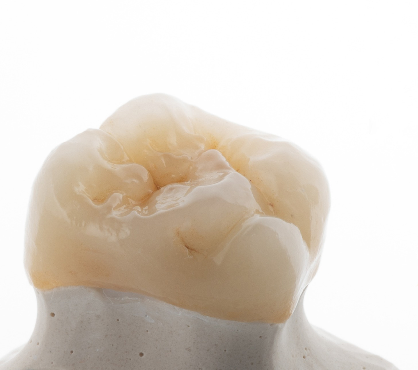 Dental restoration model